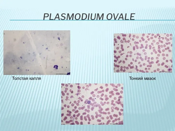 PLASMODIUM OVALE Толстая капля Тонкий мазок