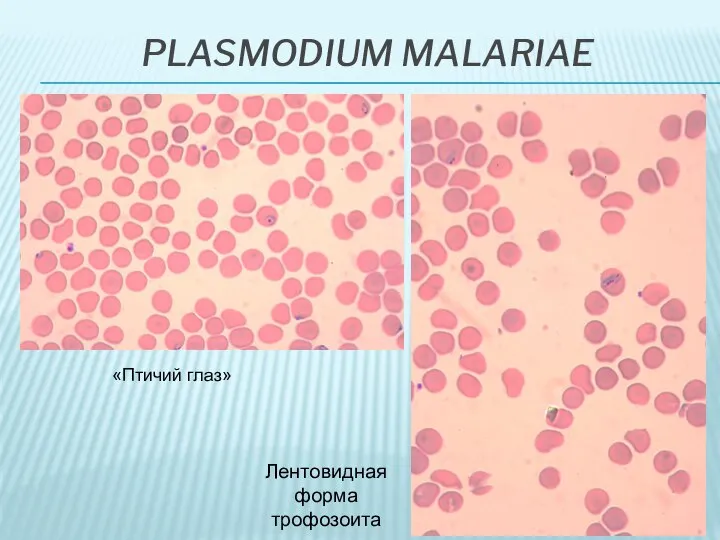 PLASMODIUM MALARIAE Лентовидная форма трофозоита «Птичий глаз»