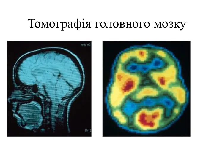Томографія головного мозку