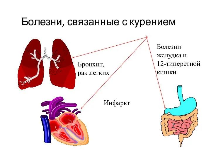 Болезни, связанные с курением Бронхит, рак легких Инфаркт Болезни желудка и 12-типерстной кишки