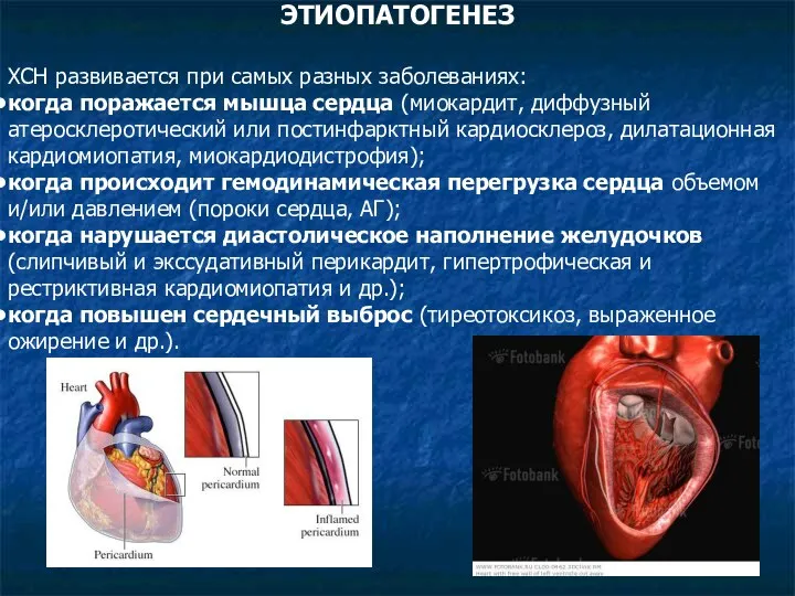 ЭТИОПАТОГЕНЕЗ ХСН развивается при самых разных заболеваниях: когда поражается мышца сердца (миокардит,