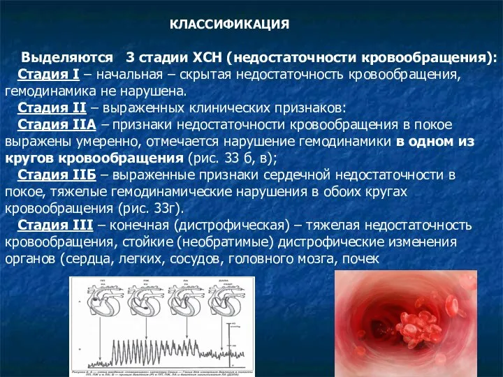 КЛАССИФИКАЦИЯ Выделяются 3 стадии ХСН (недостаточности кровообращения): Стадия I – начальная –