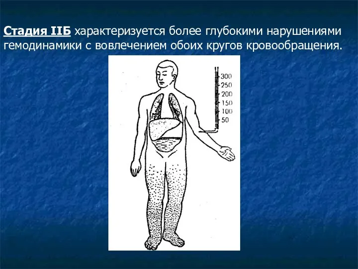 Стадия IIБ характеризуется более глубокими нарушениями гемодинамики с вовлечением обоих кругов кровообращения.