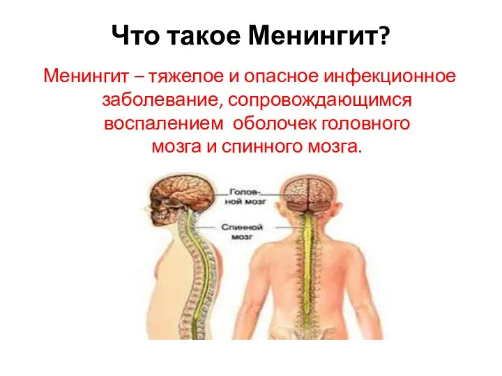 Что такое Менингит? Менингит – тяжелое и опасное инфекционное заболевание, сопровождающимся воспалением