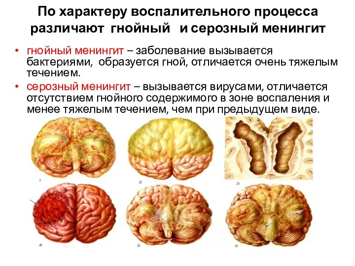 По характеру воспалительного процесса различают гнойный и серозный менингит гнойный менингит –