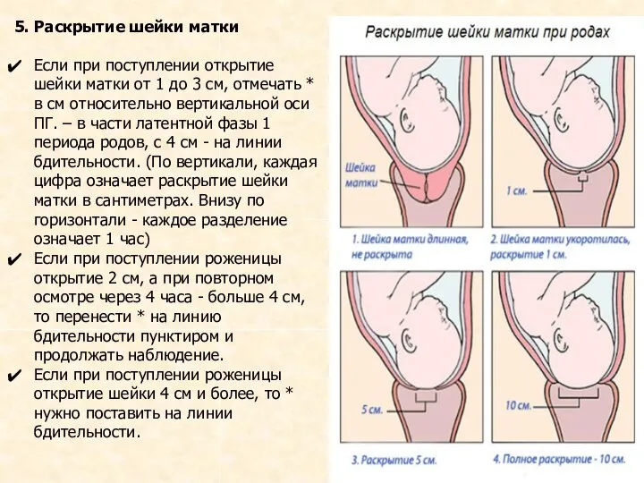 5. Раскрытие шейки матки Если при поступлении открытие шейки матки от 1