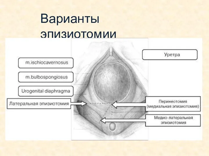 Варианты эпизиотомии