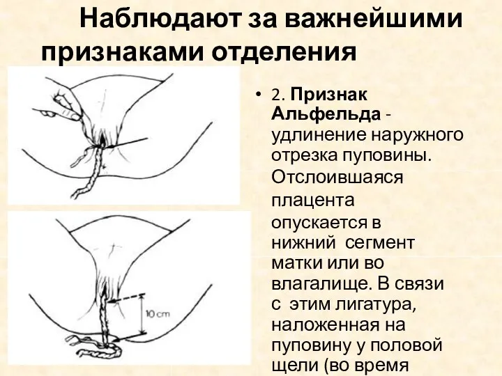 Наблюдают за важнейшими признаками отделения плаценты : 2. Признак Альфельда - удлинение