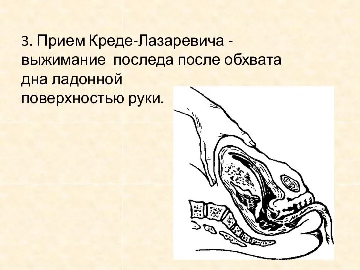 3. Прием Креде-Лазаревича - выжимание последа после обхвата дна ладонной поверхностью руки.