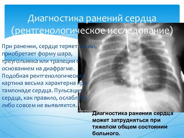 Диагностика ранений сердца (рентгенологическое исследование) При ранении, сердце теряет талию, приобретает форму
