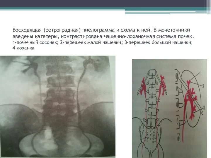 Восходящая (ретроградная) пиелограмма и схема к ней. В мочеточники введены катетеры, контрастирована