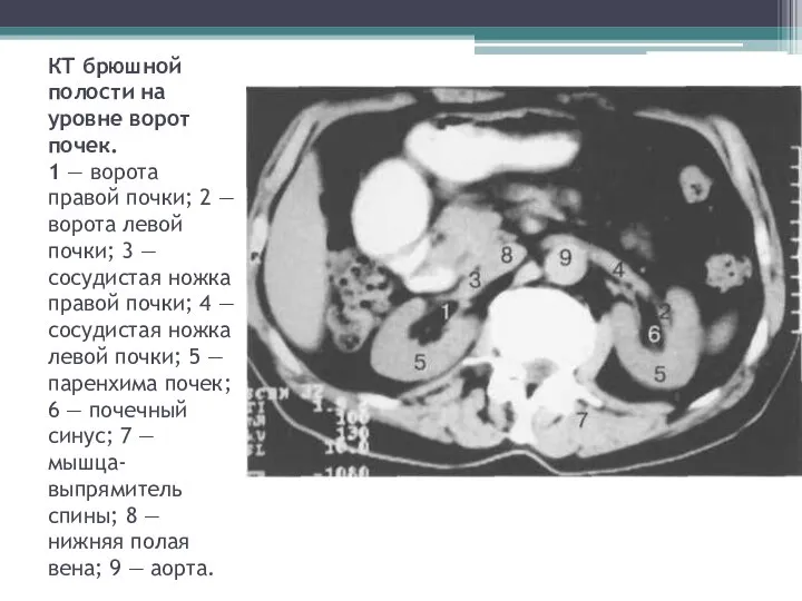 КТ брюшной полости на уровне ворот почек. 1 — ворота правой почки;