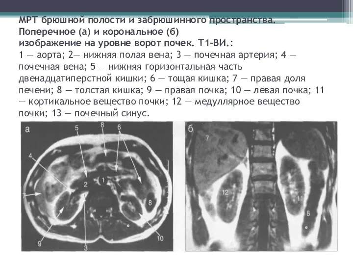 МРТ брюшной полости и забрюшинного пространства. Поперечное (а) и корональное (б) изображение