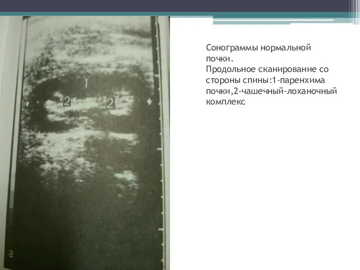 Сонограммы нормальной почки. Продольное сканирование со стороны спины:1-паренхима почки,2-чашечный-лоханочный комплекс