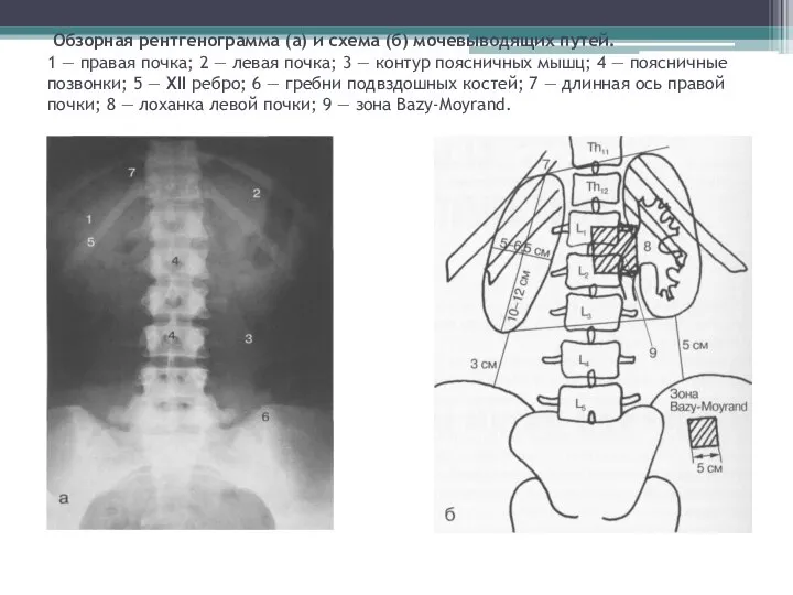 Обзорная рентгенограмма (а) и схема (б) мочевыводящих путей. 1 — правая почка;