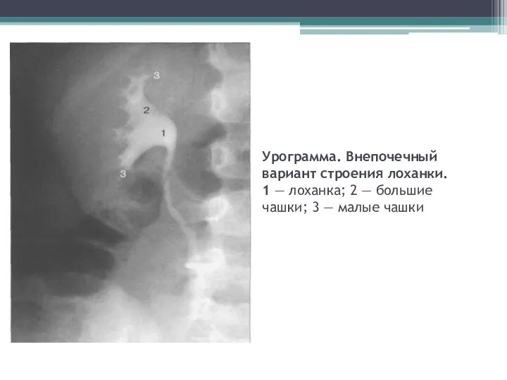 Урограмма. Внепочечный вариант строения лоханки. 1 — лоханка; 2 — большие чашки; 3 — малые чашки