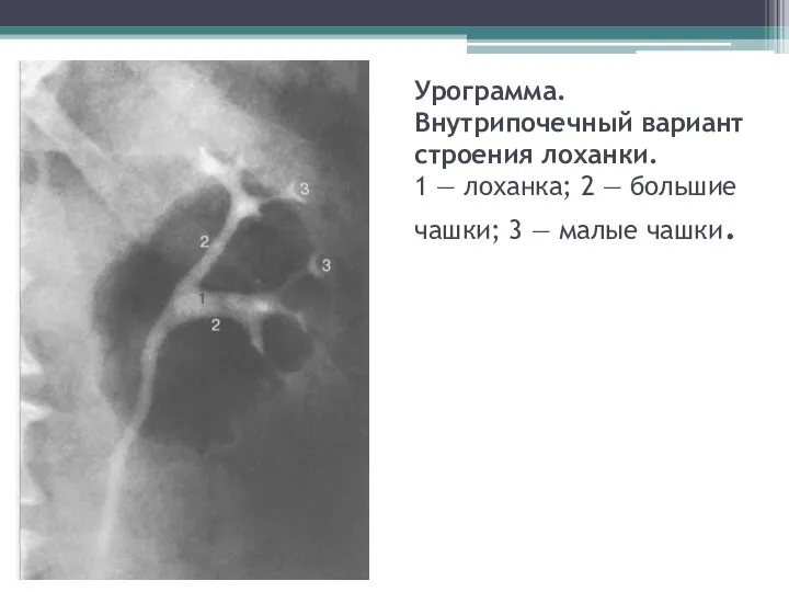 Урограмма. Внутрипочечный вариант строения лоханки. 1 — лоханка; 2 — большие чашки; 3 — малые чашки.