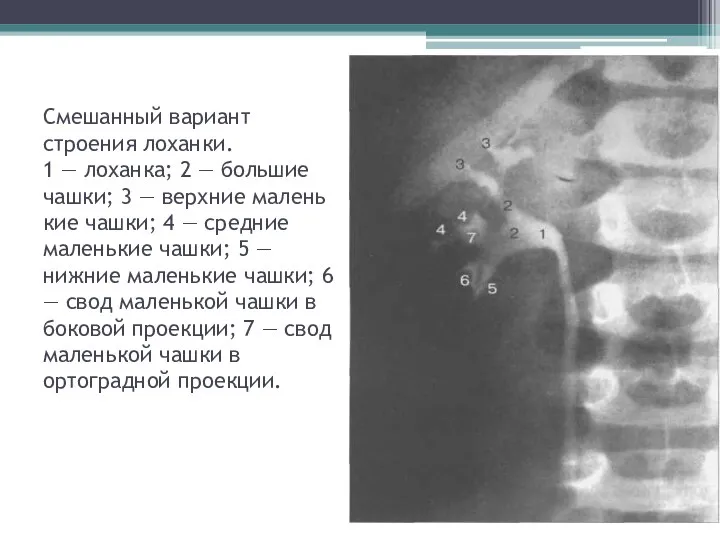 Смешанный вариант строения лоханки. 1 — лоханка; 2 — большие чашки; 3