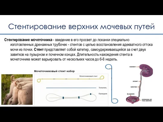 Стентирование верхних мочевых путей Стентирование мочеточника - введение в его просвет до