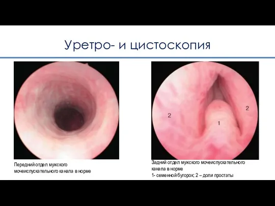 Уретро- и цистоскопия Передний отдел мужского мочеиспускательного канала в норме Задний отдел