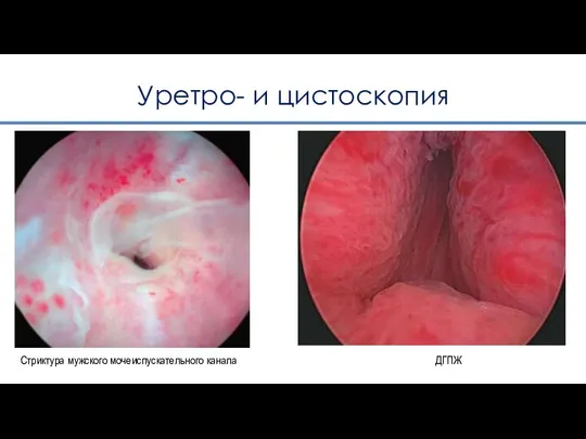 Уретро- и цистоскопия Стриктура мужского мочеиспускательного канала ДГПЖ