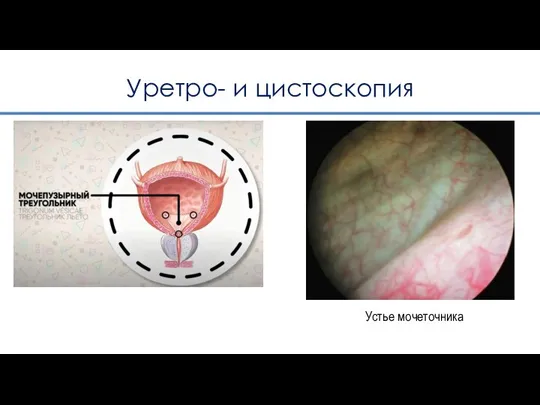 Уретро- и цистоскопия Устье мочеточника