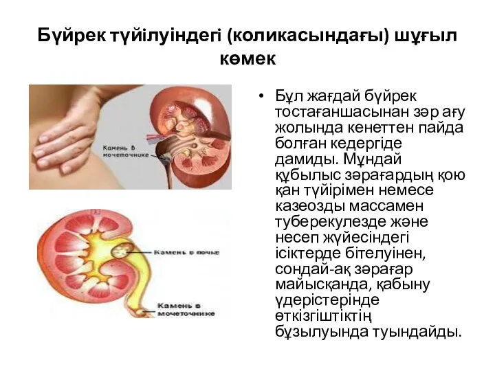 Бүйрек түйiлуіндегi (коликасындағы) шұғыл көмек Бұл жағдай бүйрек тостағаншасынан зәр ағу жолында