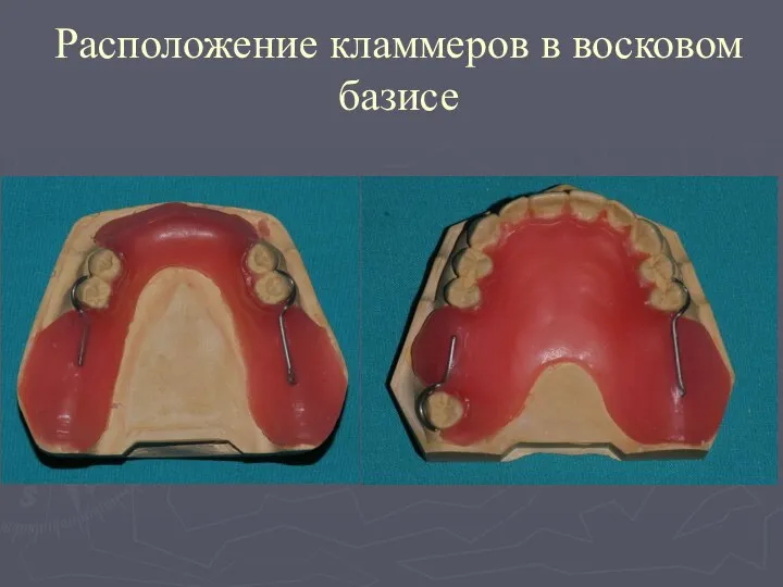 Расположение кламмеров в восковом базисе