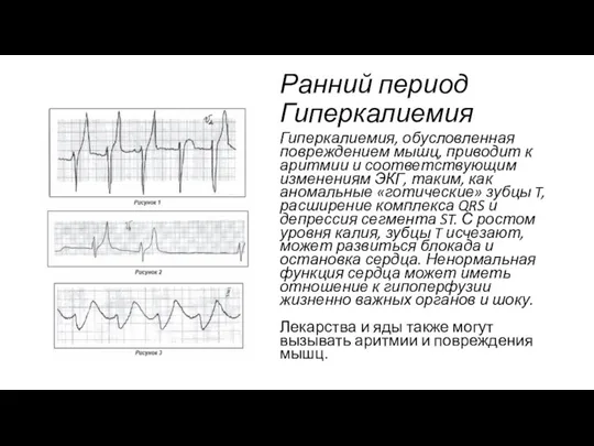 Ранний период Гиперкалиемия Гиперкалиемия, обусловленная повреждением мышц, приводит к аритмии и соответствующим