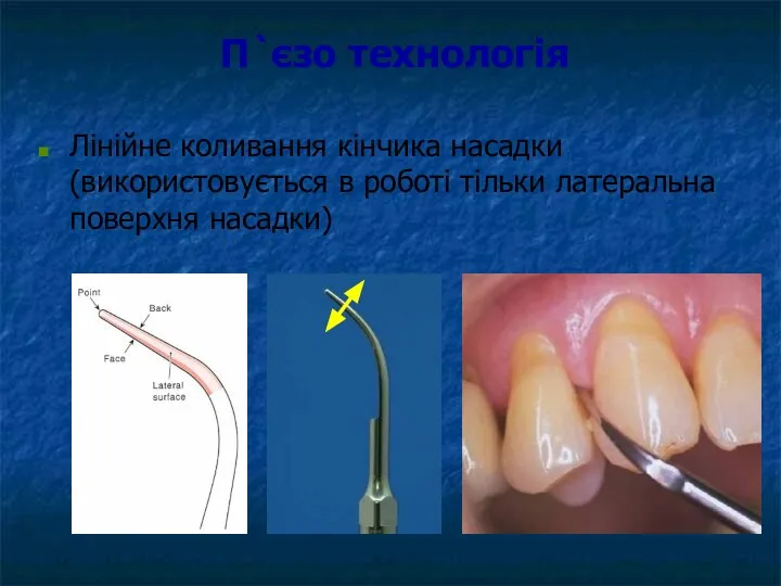 П`єзо технологія Лінійне коливання кінчика насадки(використовується в роботі тільки латеральна поверхня насадки)