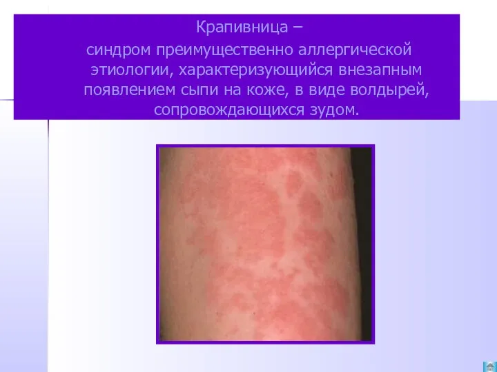 Крапивница – синдром преимущественно аллергической этиологии, характеризующийся внезапным появлением сыпи на коже,