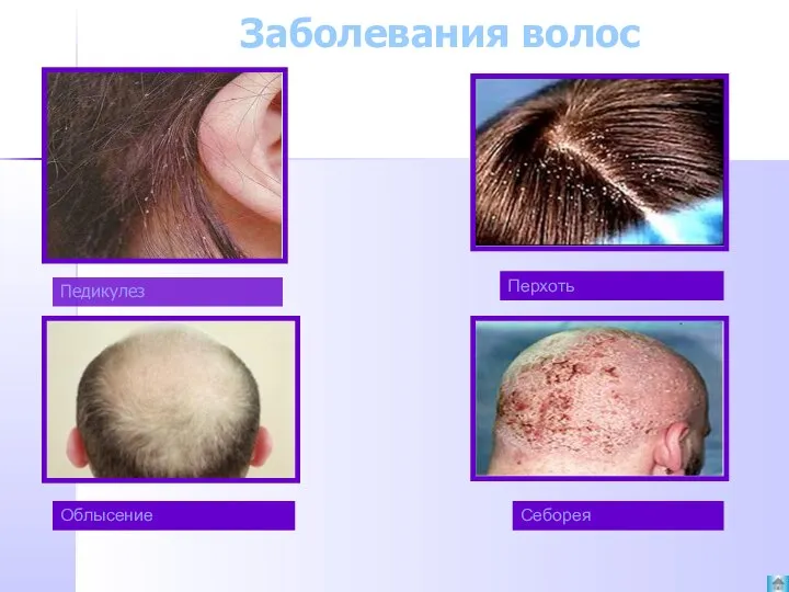 Заболевания волос Перхоть Облысение Себорея Педикулез