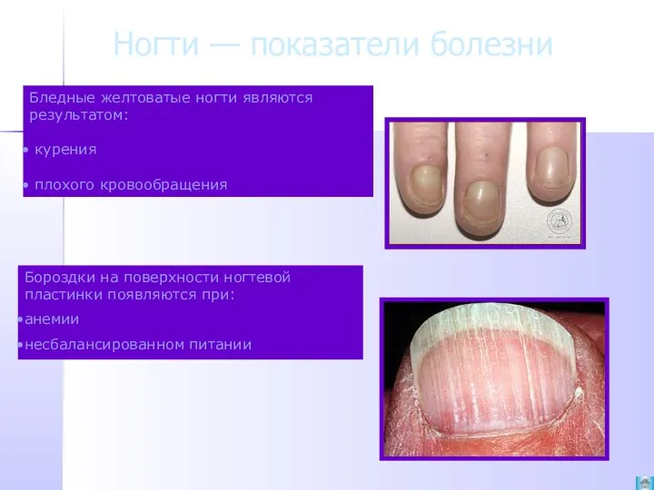 Ногти — показатели болезни Бороздки на поверхности ногтевой пластинки появляются при: анемии