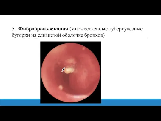 5. Фибробронхоскопия (множественные туберкулезные бугорки на слизистой оболочке бронхов)