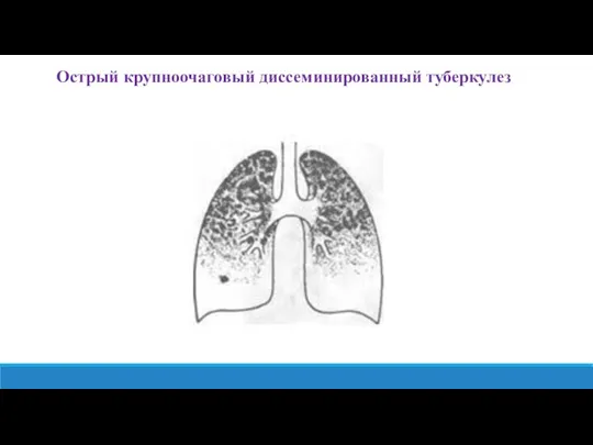 Острый крупноочаговый диссеминированный туберкулез