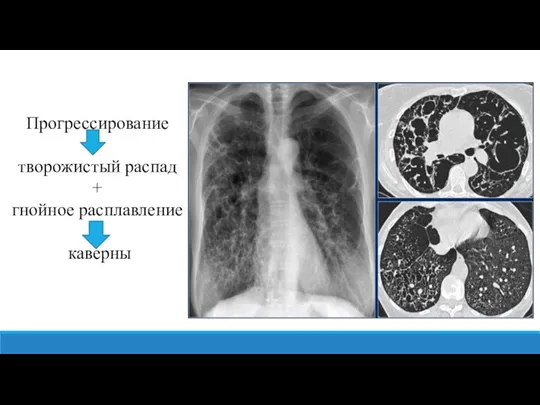 Прогрессирование творожистый распад + гнойное расплавление каверны