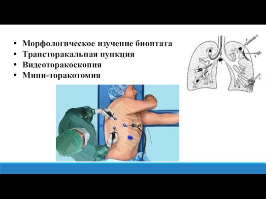 Морфологическое изучение биоптата Трансторакальная пункция Видеоторакоскопия Мини-торакотомия