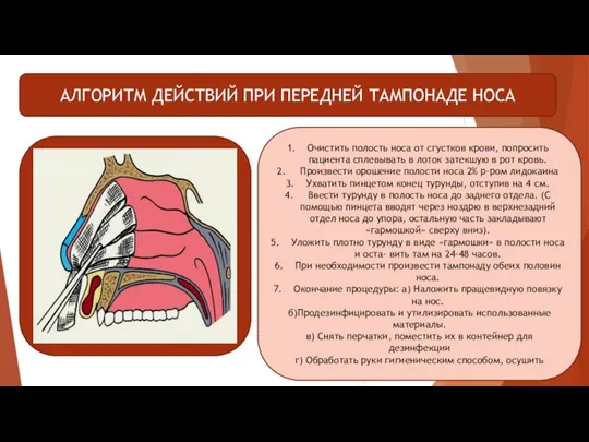 Очистить полость носа от сгустков крови, попросить пациента сплевывать в лоток затекшую