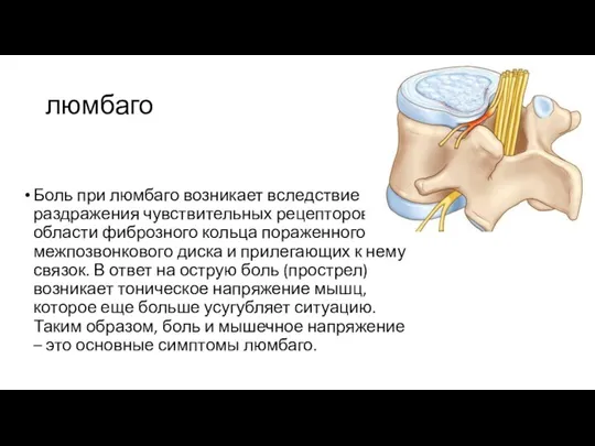 люмбаго Боль при люмбаго возникает вследствие раздражения чувствительных рецепторов в области фиброзного