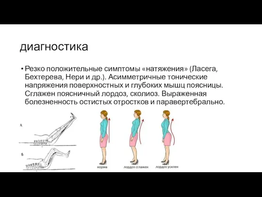 диагностика Резко положительные симптомы «натяжения» (Ласега, Бехтерева, Нери и др.). Асимметричные тонические