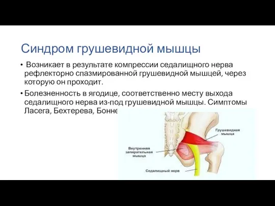 Синдром грушевидной мышцы Возникает в результате компрессии седалищного нерва рефлекторно спазмированной грушевидной