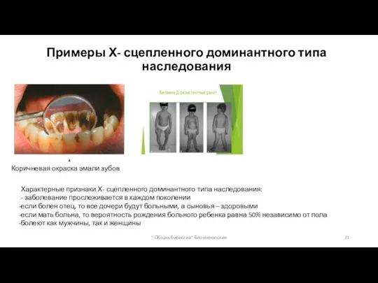 Примеры Х- сцепленного доминантного типа наследования Коричневая окраска эмали зубов Характерные признаки