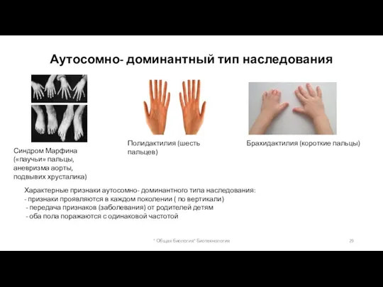 Аутосомно- доминантный тип наследования Синдром Марфина («паучьи» пальцы, аневризма аорты, подвывих хрусталика)