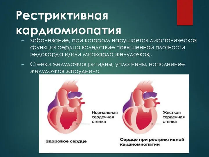 Рестриктивная кардиомиопатия заболевание, при котором нарушается диастолическая функция сердца вследствие повышенной плотности