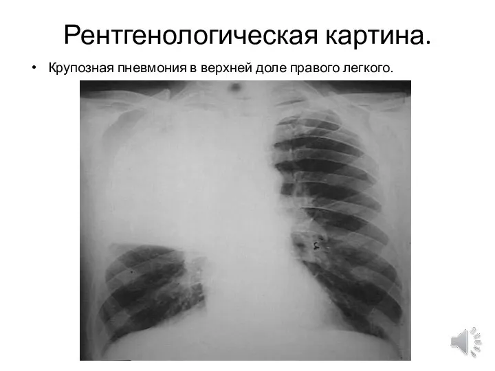 Рентгенологическая картина. Крупозная пневмония в верхней доле правого легкого.