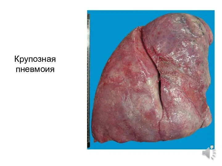 Крупозная пневмоия
