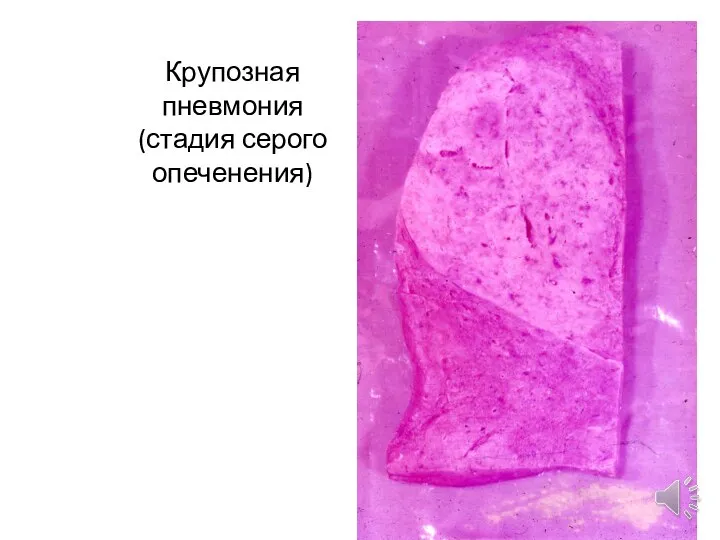 Крупозная пневмония (стадия серого опеченения)