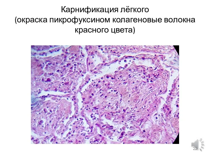 Карнификация лёгкого (окраска пикрофуксином колагеновые волокна красного цвета)