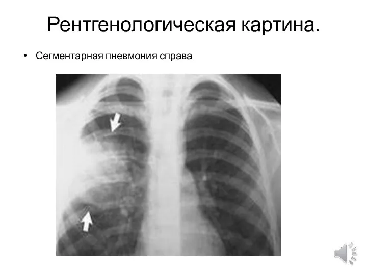 Рентгенологическая картина. Сегментарная пневмония справа