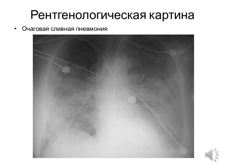 Рентгенологическая картина Очаговая сливная пневмония